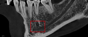 口腔ct怎么拍摄【专科天地】没有口腔CT，你根本不会想到自己的牙齿长得多“奇葩”！_https://www.jmylbn.com_新闻资讯_第8张