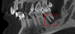 口腔ct怎么拍摄【专科天地】没有口腔CT，你根本不会想到自己的牙齿长得多“奇葩”！_https://www.jmylbn.com_新闻资讯_第9张