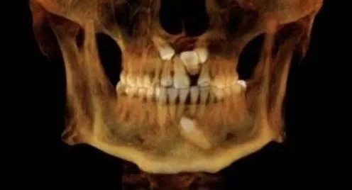 口腔ct怎么拍摄【专科天地】没有口腔CT，你根本不会想到自己的牙齿长得多“奇葩”！_https://www.jmylbn.com_新闻资讯_第14张