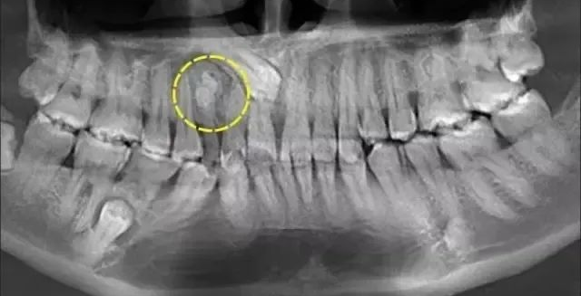 口腔ct怎么拍摄【专科天地】没有口腔CT，你根本不会想到自己的牙齿长得多“奇葩”！_https://www.jmylbn.com_新闻资讯_第6张