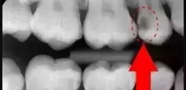 口腔ct怎么拍摄【专科天地】没有口腔CT，你根本不会想到自己的牙齿长得多“奇葩”！_https://www.jmylbn.com_新闻资讯_第7张