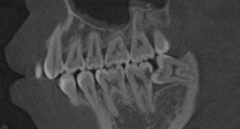 口腔ct怎么拍摄【专科天地】没有口腔CT，你根本不会想到自己的牙齿长得多“奇葩”！_https://www.jmylbn.com_新闻资讯_第15张