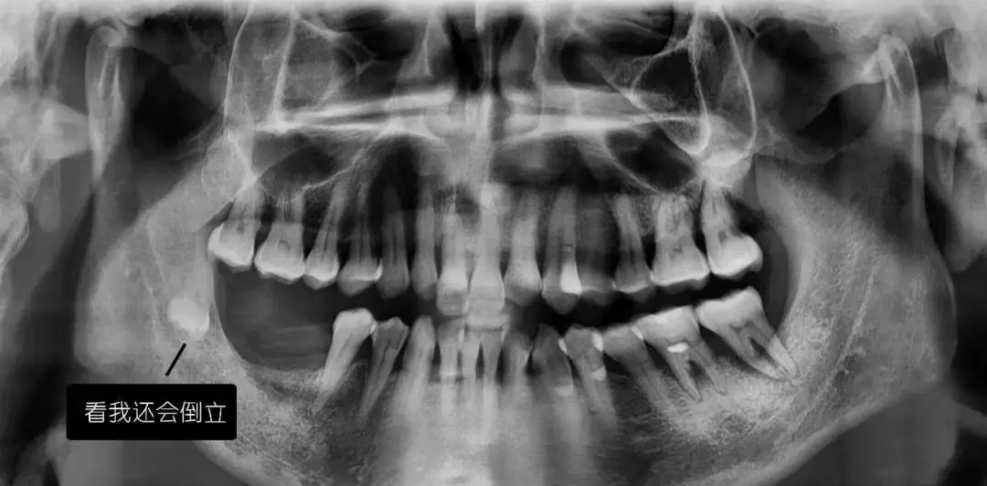 口腔ct怎么拍摄【专科天地】没有口腔CT，你根本不会想到自己的牙齿长得多“奇葩”！_https://www.jmylbn.com_新闻资讯_第5张
