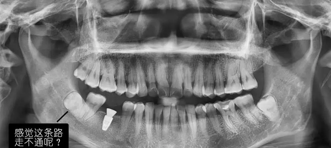 口腔ct怎么拍摄【专科天地】没有口腔CT，你根本不会想到自己的牙齿长得多“奇葩”！_https://www.jmylbn.com_新闻资讯_第4张
