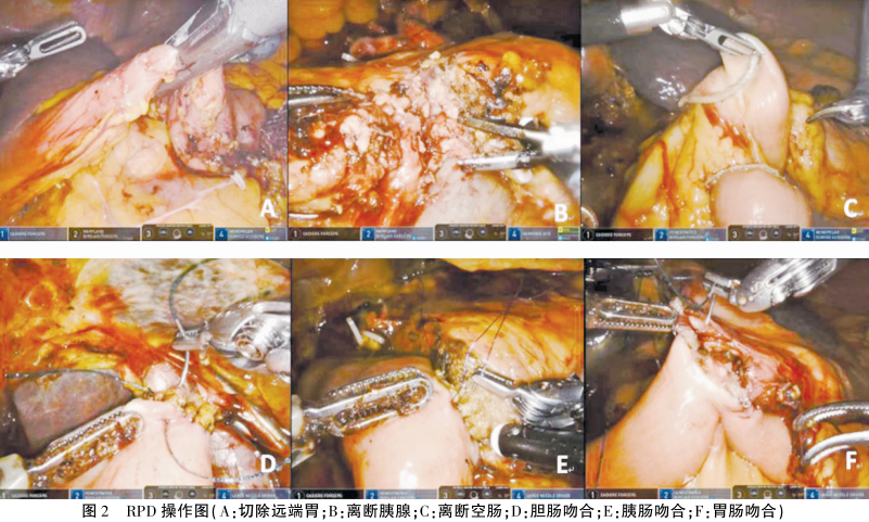 为什么叫哈巴狗钳达芬奇机器人在胰腺手术中的应用_https://www.jmylbn.com_新闻资讯_第2张