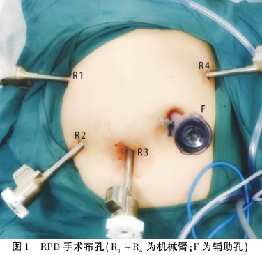 为什么叫哈巴狗钳达芬奇机器人在胰腺手术中的应用_https://www.jmylbn.com_新闻资讯_第1张