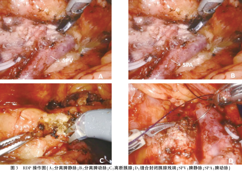 为什么叫哈巴狗钳达芬奇机器人在胰腺手术中的应用_https://www.jmylbn.com_新闻资讯_第3张