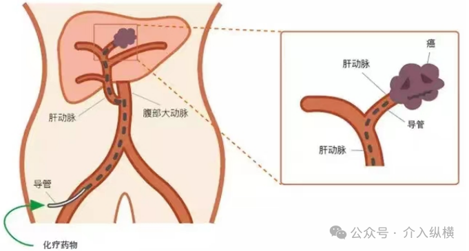 介入用的什么设备介入科普 ｜ 介入常用的治疗手段-上海聚慕医疗器械有限公司