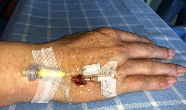 留置针胶布怎么撕应对留置针滴速减慢，这个方法「全国统一」？_https://www.jmylbn.com_新闻资讯_第6张