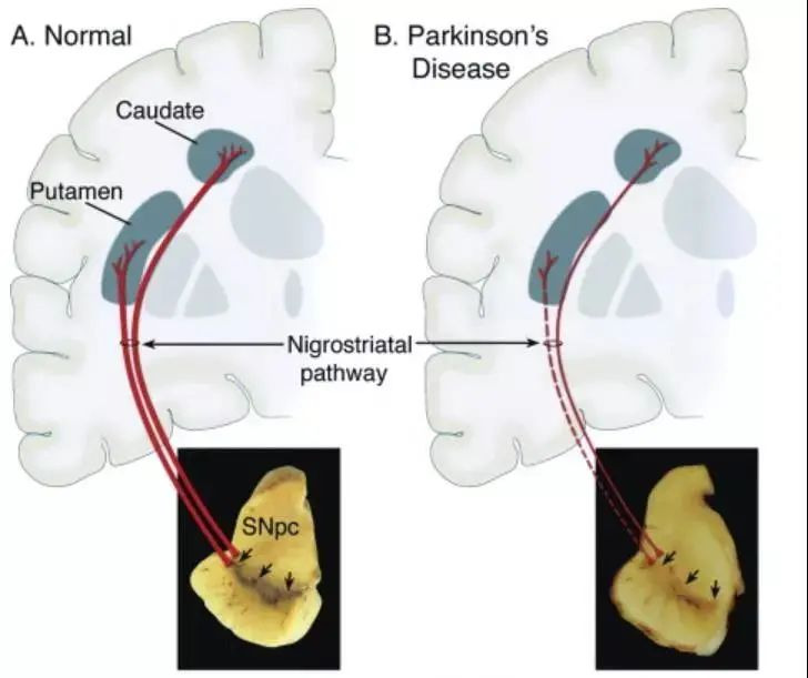 正式批准：12月开始静脉和脊髓腔注射干细胞治疗帕金森病(图2)