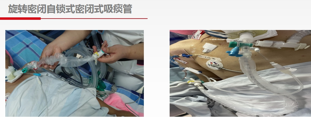 为什么使用密闭式吸痰管技术创新，让密闭式吸痰更安全、便捷、舒适！_https://www.jmylbn.com_新闻资讯_第9张