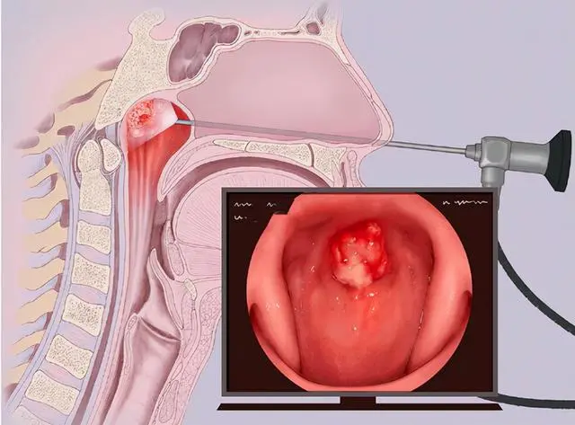 耳鼻喉内窥镜检查是检查什么耳鼻喉科学防护——耳鼻喉内窥镜检查_https://www.jmylbn.com_新闻资讯_第9张