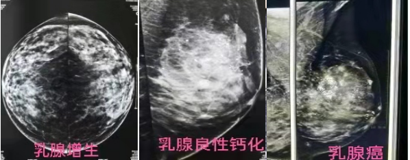数字钼靶是什么【科普】乳腺数字钼靶，呵护女性健康_https://www.jmylbn.com_新闻资讯_第9张