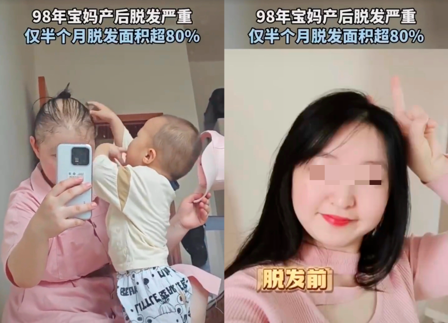 秃头神药，辉瑞专供有钱人