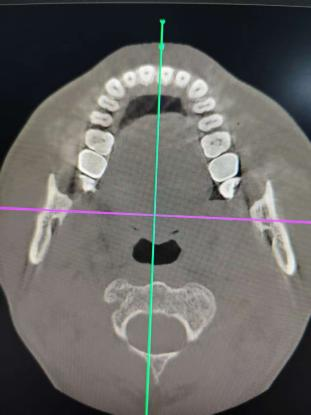 口腔ct怎么拍摄口腔CT_https://www.jmylbn.com_新闻资讯_第3张