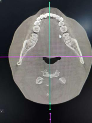 口腔ct怎么拍摄口腔CT_https://www.jmylbn.com_新闻资讯_第2张