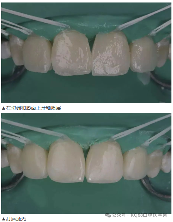 11、21之间存在4.5mm间隙你该如何修复？