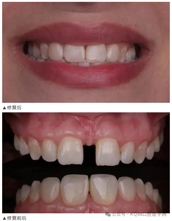 11、21之间存在4.5mm间隙你该如何修复？