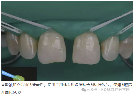 11、21之间存在4.5mm间隙你该如何修复？