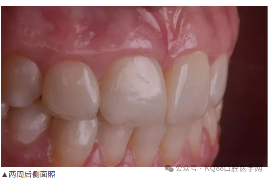 11、21之间存在4.5mm间隙你该如何修复？