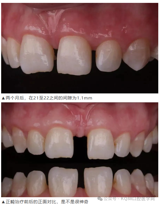 11、21之间存在4.5mm间隙你该如何修复？