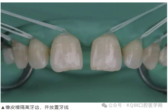 11、21之间存在4.5mm间隙你该如何修复？