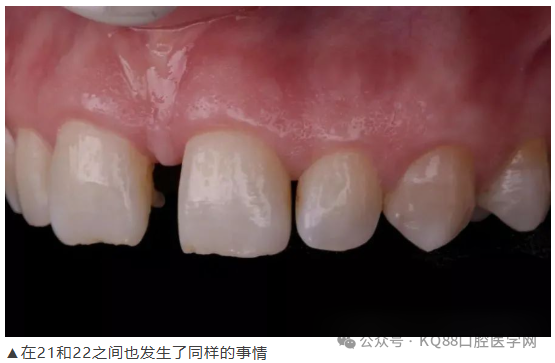 11、21之间存在4.5mm间隙你该如何修复？