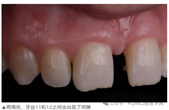 11、21之间存在4.5mm间隙你该如何修复？