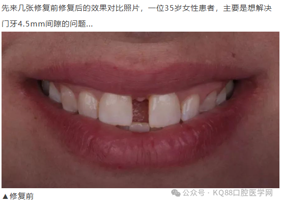 11、21之间存在4.5mm间隙你该如何修复？