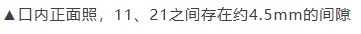 11、21之间存在4.5mm间隙你该如何修复？