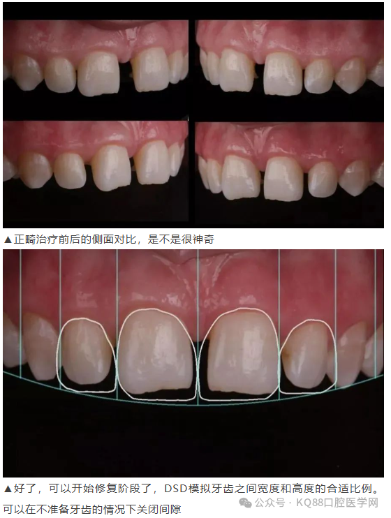 11、21之间存在4.5mm间隙你该如何修复？