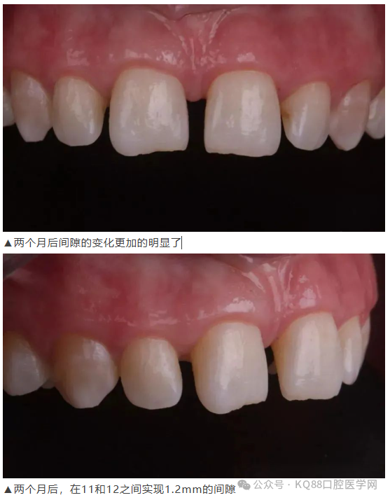 11、21之间存在4.5mm间隙你该如何修复？