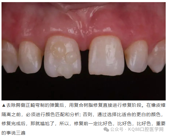 11、21之间存在4.5mm间隙你该如何修复？