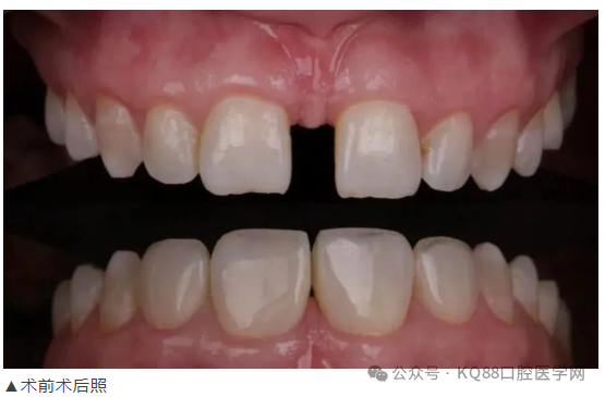 11、21之间存在4.5mm间隙你该如何修复？
