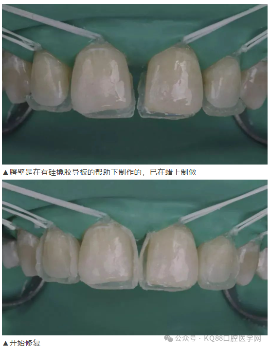 11、21之间存在4.5mm间隙你该如何修复？