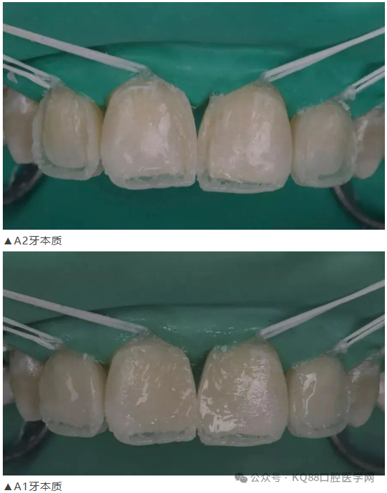 11、21之间存在4.5mm间隙你该如何修复？