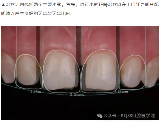 11、21之间存在4.5mm间隙你该如何修复？