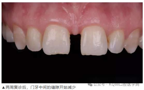 11、21之间存在4.5mm间隙你该如何修复？