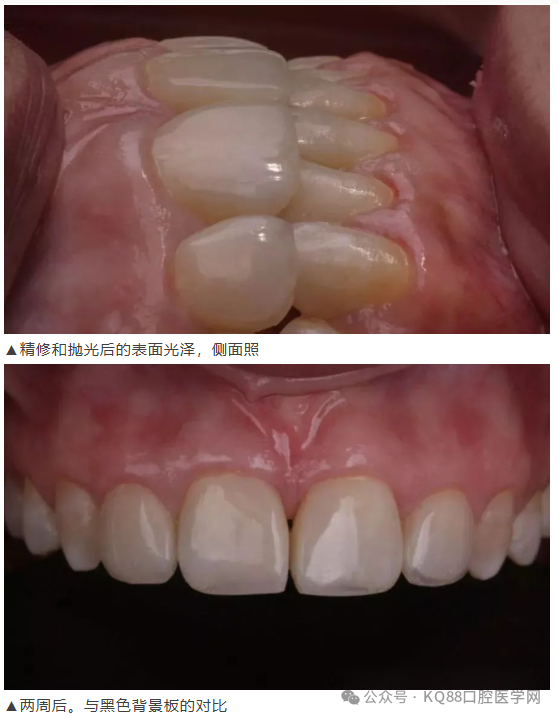 11、21之间存在4.5mm间隙你该如何修复？