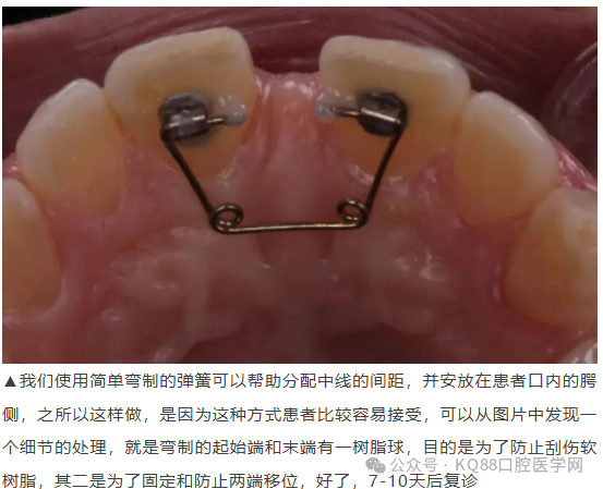 11、21之间存在4.5mm间隙你该如何修复？