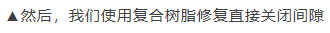 11、21之间存在4.5mm间隙你该如何修复？