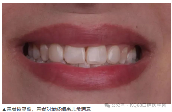 11、21之间存在4.5mm间隙你该如何修复？