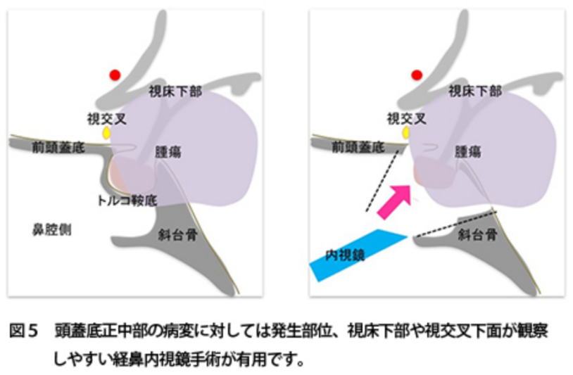 内窥镜微创颅底手术