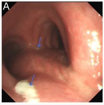 气腹管怎么接只因给氧方式不妥，气管镜术中病人突发腹胀、休克、呼吸衰竭_https://www.jmylbn.com_新闻资讯_第2张