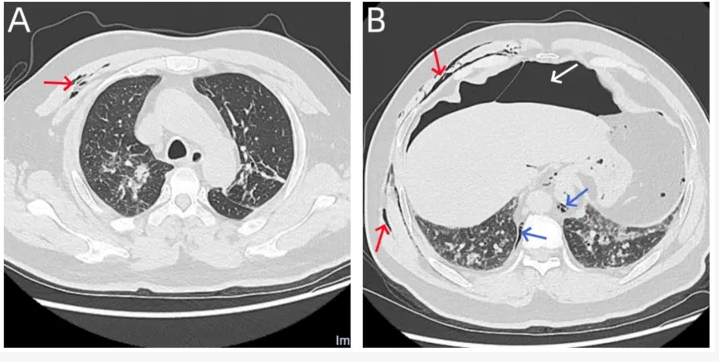 气腹管怎么接只因给氧方式不妥，气管镜术中病人突发腹胀、休克、呼吸衰竭_https://www.jmylbn.com_新闻资讯_第6张
