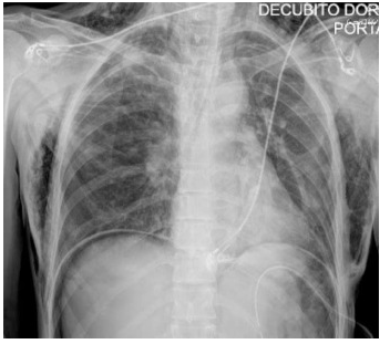 气腹管怎么接只因给氧方式不妥，气管镜术中病人突发腹胀、休克、呼吸衰竭_https://www.jmylbn.com_新闻资讯_第7张
