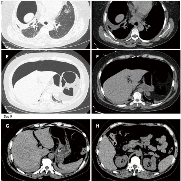 气腹管怎么接只因给氧方式不妥，气管镜术中病人突发腹胀、休克、呼吸衰竭_https://www.jmylbn.com_新闻资讯_第10张