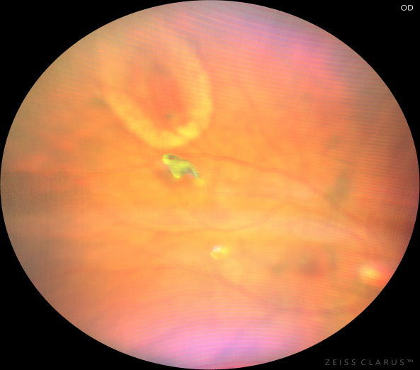 眼底激光机有什么牌子新技术新设备助推医院眼科前行——眼科开展“视网膜激光光凝术”新项目_https://www.jmylbn.com_新闻资讯_第13张