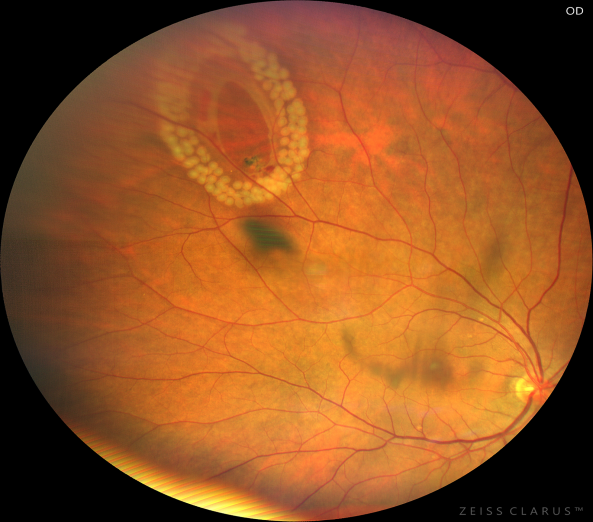 眼底激光机有什么牌子新技术新设备助推医院眼科前行——眼科开展“视网膜激光光凝术”新项目_https://www.jmylbn.com_新闻资讯_第14张