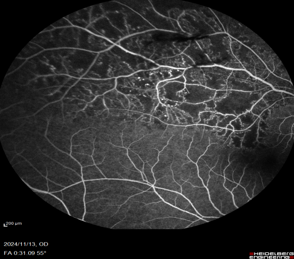 眼底激光机有什么牌子新技术新设备助推医院眼科前行——眼科开展“视网膜激光光凝术”新项目_https://www.jmylbn.com_新闻资讯_第11张